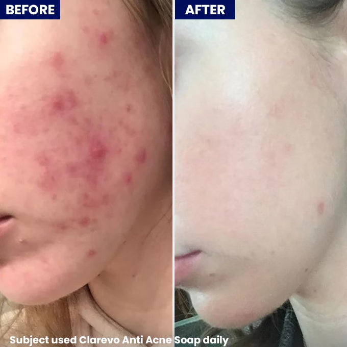 Jenpharm Clarevo Anti Acne Soap