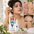 VCare Naturlas Acne Serum - 30ml