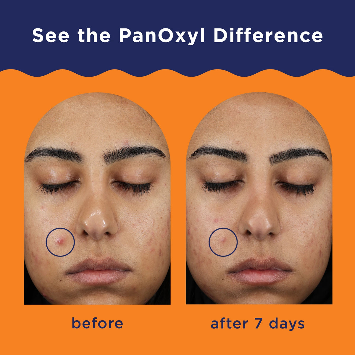 PanOxyl Acne Clearing Spot Treatment - 10% BPO